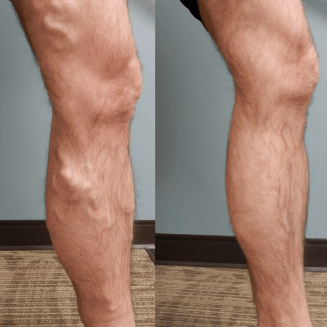 Set de plasturi pentru vene varicoase